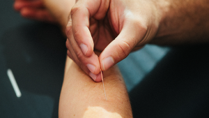 Electro Dry Needling - South Melbourne